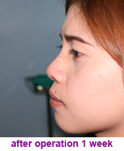 plastic_surgery_augmentation_rhinoplasty